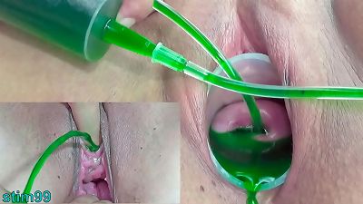 Cervix and piss hole Inflation with insertions for chinese lesbians